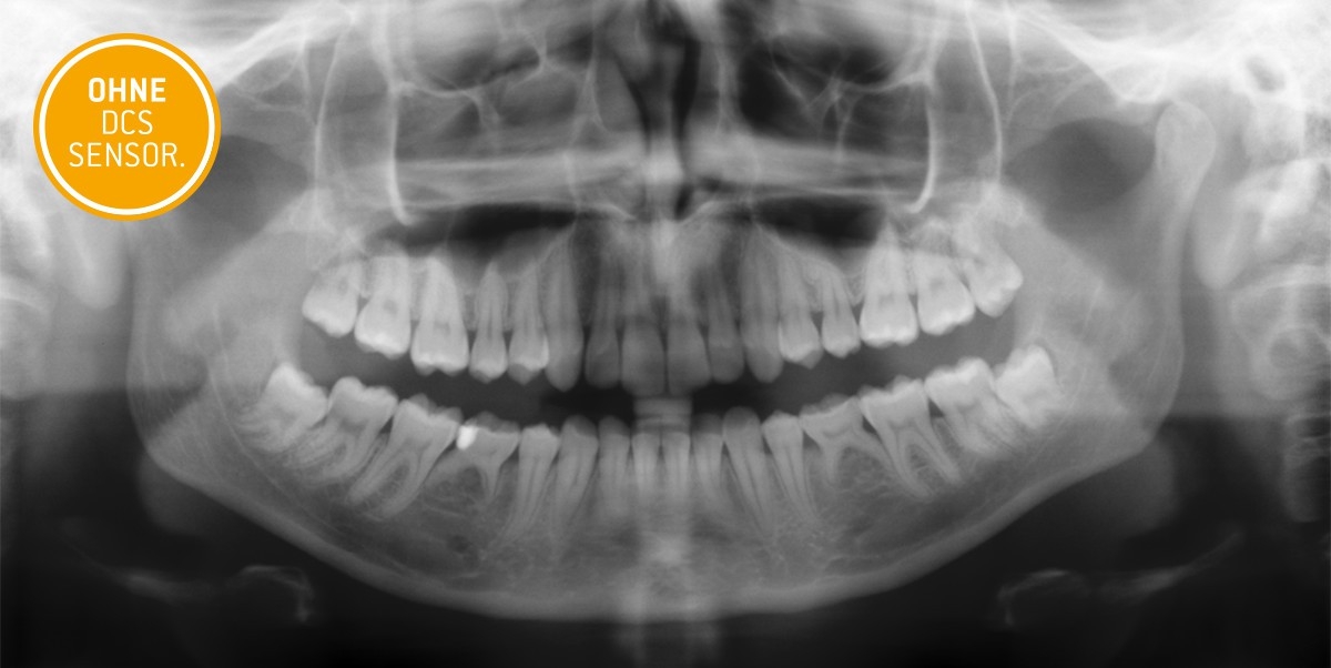 Röntgenaufnahme ohne DCS Sensor